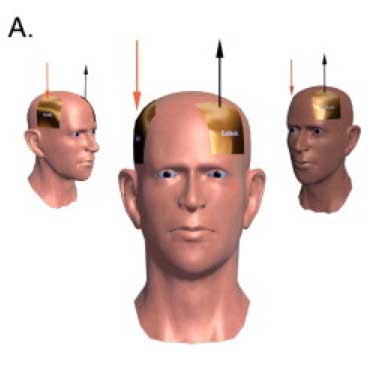 A-M1-C-contralateral-supraorbital